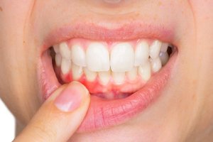 Doen A Periodontal Veja Como Identificar Os Sintomas Naso