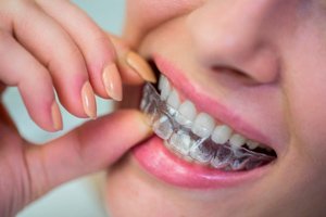 Planet Dente GRU - Clínica Odontológica - O aparelho dentário fixo  transparente é ideal para quem precisa de tratamento ortodôntico, mas não  quer aquele sorriso metálico, comum nos adolescentes. Entre os transparentes